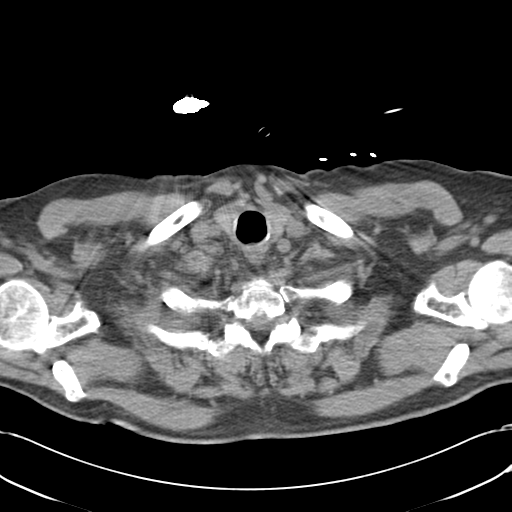 File:Aortic intramural hematoma (Radiopaedia 34260-35540 Axial non-contrast 5).png