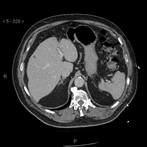 Aortic intramural hematoma (Radiopaedia 48463-53380 C 148).jpg