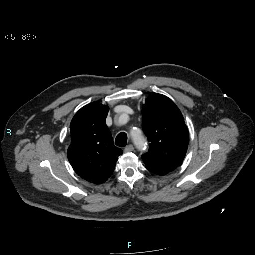 Aortic intramural hematoma (Radiopaedia 48463-53380 C 40).jpg