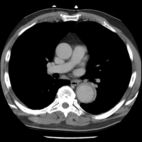 Aortic intramural hematoma (type B) (Radiopaedia 79323-92387 Axial C+ delayed 25).jpg