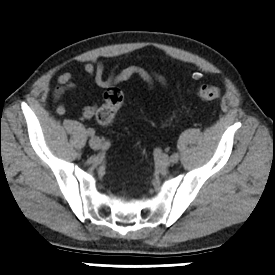 Aortic intramural hematoma (type B) (Radiopaedia 79323-92387 Axial non-contrast 97).jpg