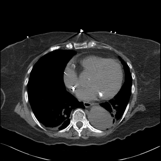 Aortic intramural hematoma with dissection and intramural blood pool (Radiopaedia 77373-89491 Axial non-contrast 63).jpg