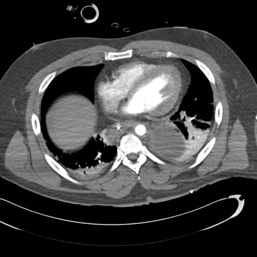 Aortic transection, diaphragmatic rupture and hemoperitoneum in a complex multitrauma patient (Radiopaedia 31701-32622 A 56).jpg