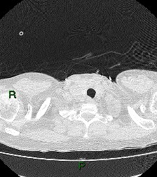 File:Aortic valve endocarditis (Radiopaedia 87209-103485 Axial lung window 9).jpg