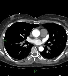 Aortic valve endocarditis (Radiopaedia 87209-103485 C 48).jpg