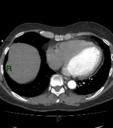 Aortic valve endocarditis (Radiopaedia 87209-103485 C 67).jpg