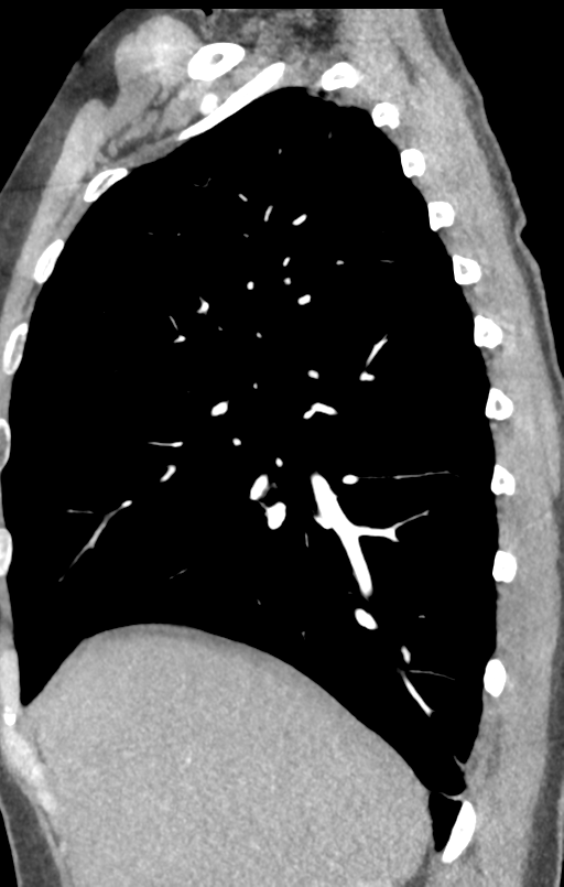 Aortic valve non-coronary cusp thrombus (Radiopaedia 55661-62189 C+ arterial phase 51).png