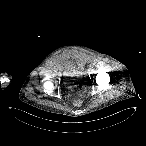 Aortoduodenal fistula (Radiopaedia 75286-86415 Axial non-contrast 69).jpg