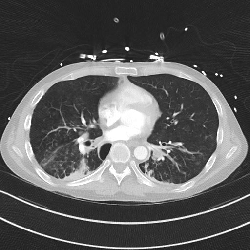 Apical bullous disease in a heavy smoker (Radiopaedia 33067-34092 Axial lung window 38).png