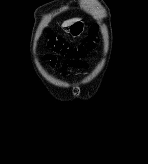 Appendiceal adenocarcinoma complicated by retroperitoneal abscess (Radiopaedia 58007-65039 A 8).jpg