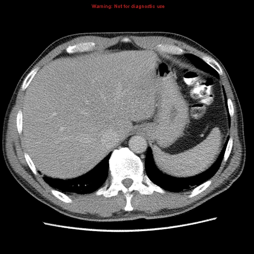 Appendicitis and renal cell carcinoma (Radiopaedia 17063-16760 A 8).jpg