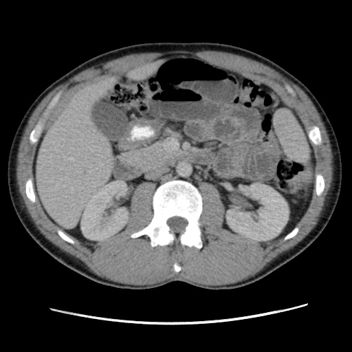 File:Appendicitis complicated by post-operative collection (Radiopaedia 35595-37114 A 34).jpg