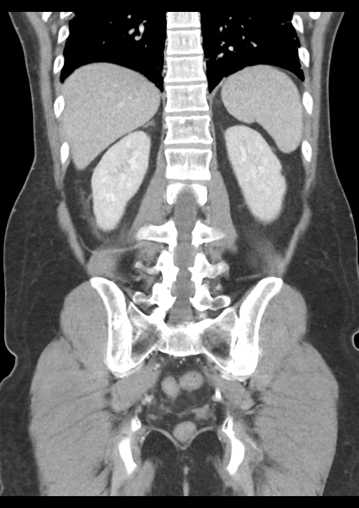 Appendicitis with thickening of the terminal ileum (Radiopaedia 42432-45550 B 43).png