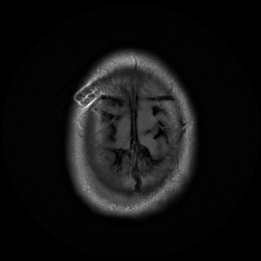 File:Aqueduct stenosis due to web (Radiopaedia 42207-45273 Axial FLAIR 23).png