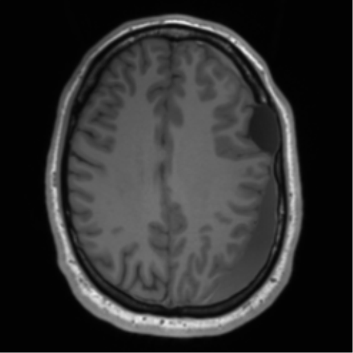 File:Arachnoid cyst with subdural hematoma (Radiopaedia 85892-101743 Axial T1 59).png
