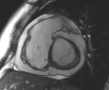 File:Arrhythmogenic right ventricular cardiomyopathy (Radiopaedia 69431-79307 Short axis cine 164).jpg
