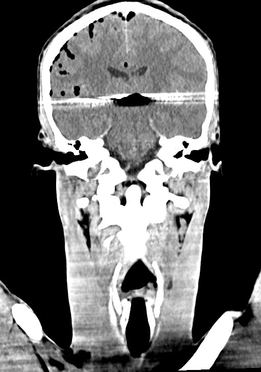 Arrow injury to the brain (Radiopaedia 72101-82607 Coronal non-contrast 44).jpg