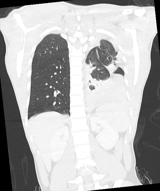 Arrow injury to the chest (Radiopaedia 85367-100975 Coronal lung window 96).jpg