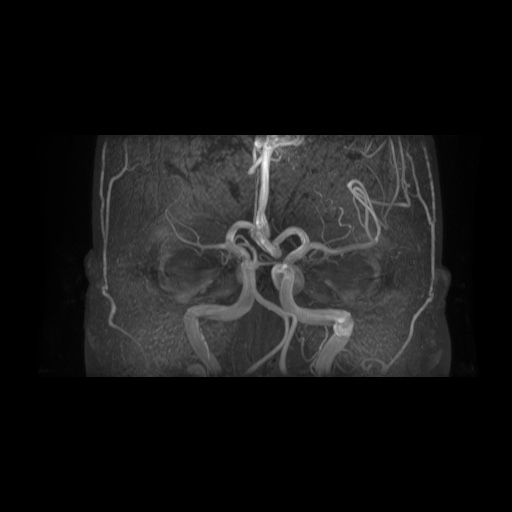 Arteriovenous malformation (Radiopaedia 71628-81999 Axial MRA 11).jpg