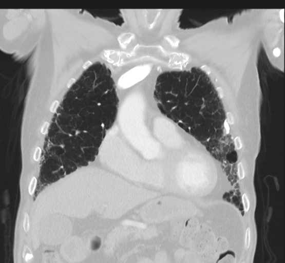 Asbestosis (Radiopaedia 56192-62864 Coronal lung window 16).png