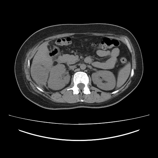 Ascending retrocecal appendicitis with liver abscesses (Radiopaedia 60066-67615 Axial non-contrast 33).jpg