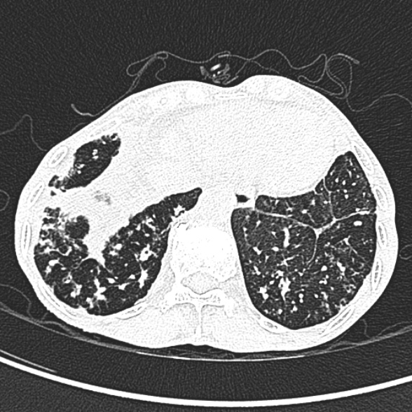 File:Aspergilloma- with Monod sign (Radiopaedia 44737-48532 Axial lung window 250).jpg