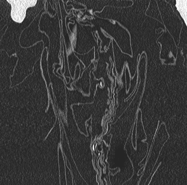 Aspergilloma- with Monod sign (Radiopaedia 44737-48532 Coronal lung window 92).jpg