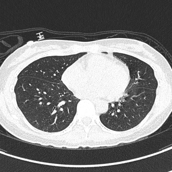 Aspergilloma (Radiopaedia 26223-26347 Axial lung window 49).jpg