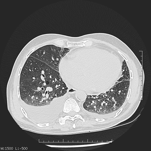 Aspergilloma (Radiopaedia 75184-86270 Axial lung window 36).jpg