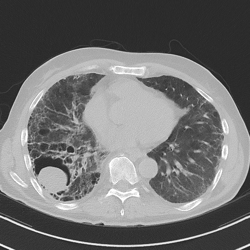 Aspergilloma on background pulmonary fibrosis (Radiopaedia 60942-68757 A 36).jpg