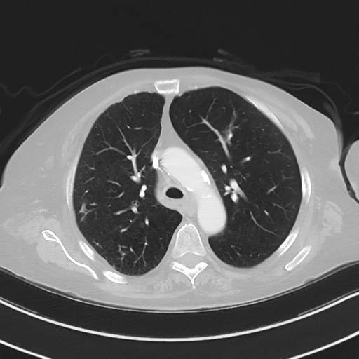 Aspiration bronchiolitis (Radiopaedia 53464-59463 Axial lung window 19).png