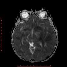 Astroblastoma (Radiopaedia 74287-85162 Axial ADC 27).jpg