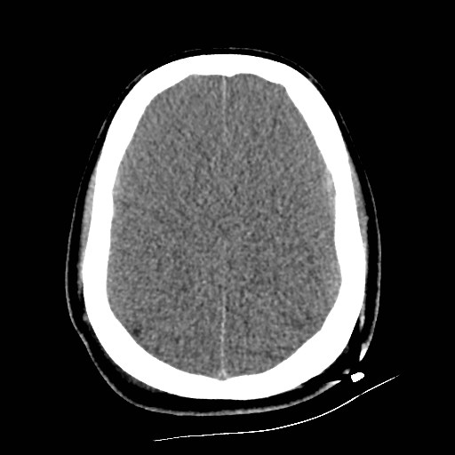 Atlanto-occipital dislocation (Radiopaedia 44648-48412 Axial non-contrast 41).jpg