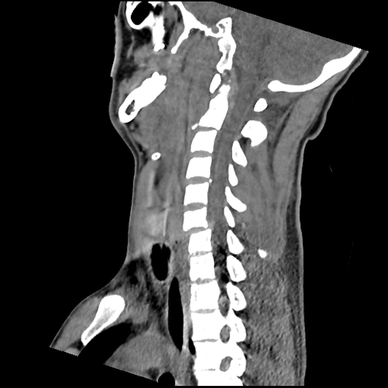 File:Atlanto-occipital dissociation (Traynelis type 1), C2 teardrop fracture, C6-7 facet joint dislocation (Radiopaedia 87655-104061 D 49).jpg