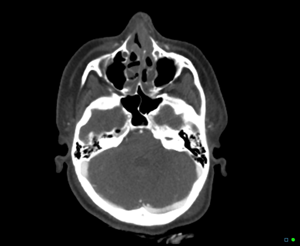 Atlanto-occipital dissociation - Traynelis type 1 (Radiopaedia 87570-103949 A 64).jpg