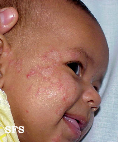Atopic Dermatitis (Dermatology Atlas 13).jpg