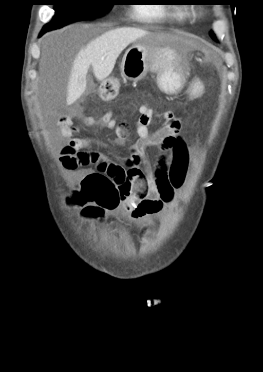 Atraumatic splenic rupture (Radiopaedia 42931-46160 B 12).png