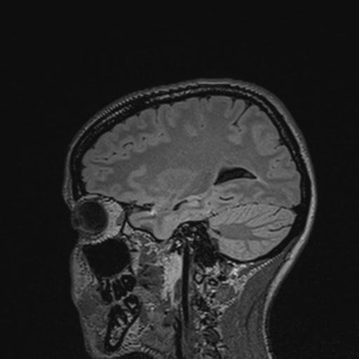 Atretic encephalocoele with inferior vermis hypoplasia (Radiopaedia 30443-31108 Sagittal FLAIR 109).jpg