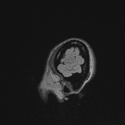 Atretic encephalocoele with inferior vermis hypoplasia (Radiopaedia 30443-31108 Sagittal FLAIR 142).jpg