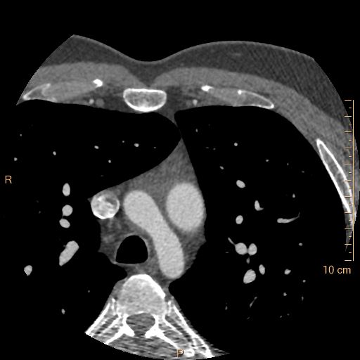 File:Atrial septal defect (upper sinus venosus type) with partial anomalous pulmonary venous return into superior vena cava (Radiopaedia 73228-83961 A 14).jpg