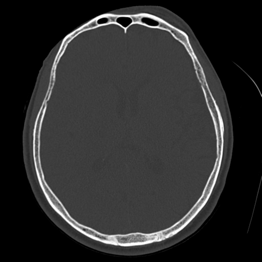 Atypical meningioma (WHO grade II) with osseous invasion (Radiopaedia 53654-59715 Axial bone window 45).png