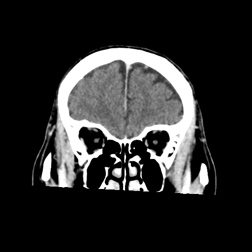 File:Atypical meningioma (WHO grade II) with osseous invasion (Radiopaedia 53654-59715 Coronal C+ delayed 15).png