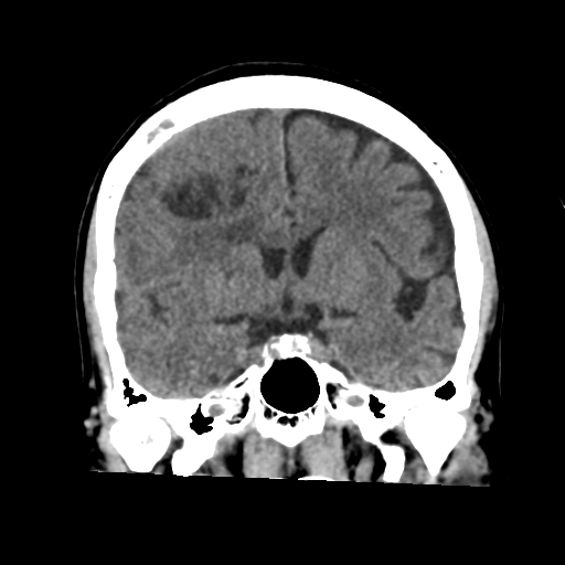 Atypical meningioma with skull invasion (Radiopaedia 34357-35649 Coronal non-contrast 30).png