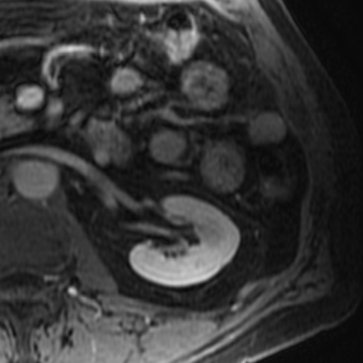 File:Atypical renal cyst on MRI (Radiopaedia 17349-17046 D 19).jpg