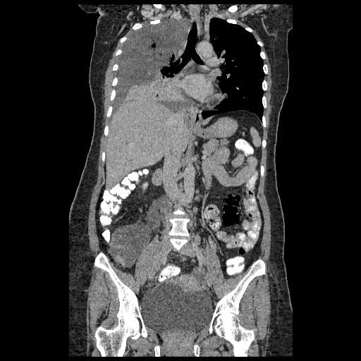 File:Atypical retroperitoneal lymphocoeles with large leiomyoma of uterus (Radiopaedia 32084-33024 B 12).jpg
