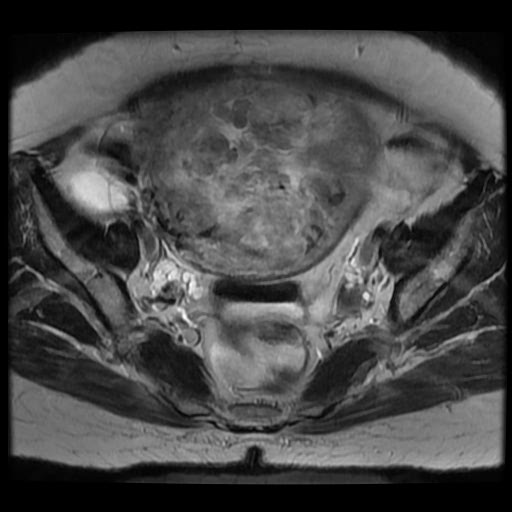 File:Atypical retroperitoneal lymphocoeles with large leiomyoma of uterus (Radiopaedia 32084-33027 Axial T2 19).jpg