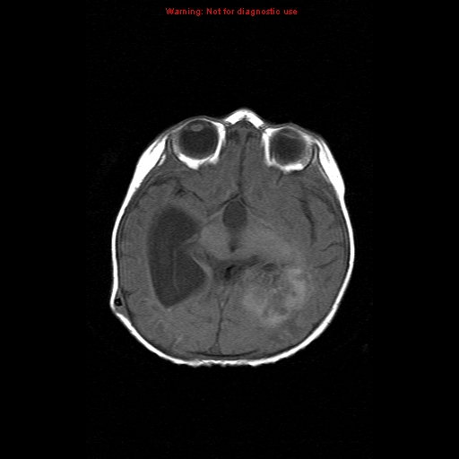File:Atypical teratoid rhabdoid tumor (Radiopaedia 10712-11183 Axial T1 10).jpg