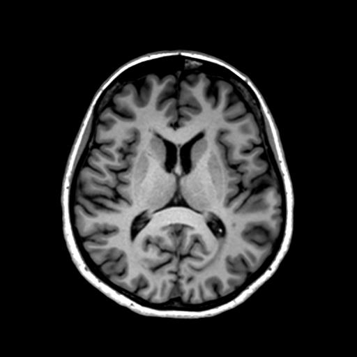 Autoimmune limbic encephalitis (Radiopaedia 30363-31005 T1 Axial 1mm 85).jpg