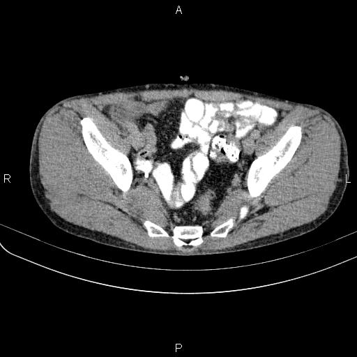 Autoimmune pancreatitis (Radiopaedia 84925-100431 Axial C+ delayed 79).jpg