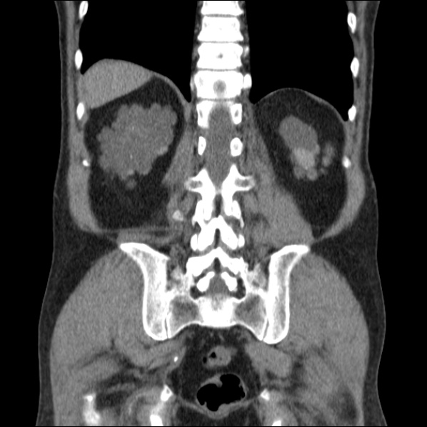 File:Autosomal dominant polycystic kidney disease (Radiopaedia 36539-38101 C 53).jpg